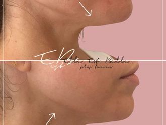 Rejuvenecimiento facial antes y después - 876998