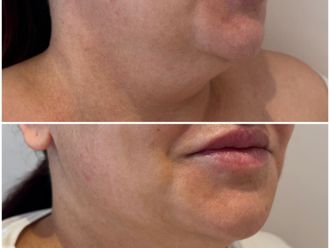 Rejuvenecimiento facial antes y después - 877001