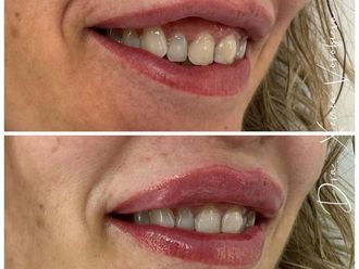 Aumento labios antes y después - 877002