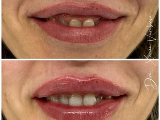 Aumento labios antes y después - 877003