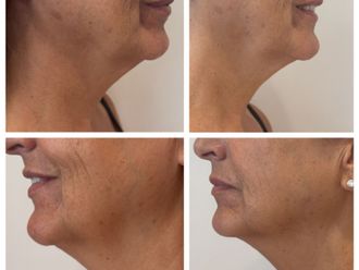 Radiofrecuencia facial antes y después - 877004
