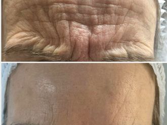 Eliminación arrugas antes y después - 877005