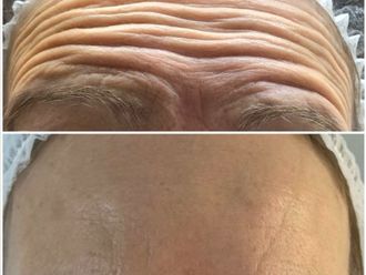 Eliminación arrugas antes y después - 877006