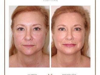 Eliminación arrugas antes y después - 877007