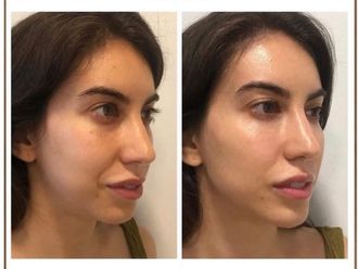 Ácido hialurónico antes y después - 877491