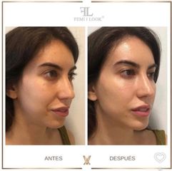 XV Clinic - Tratamiento FemiLook