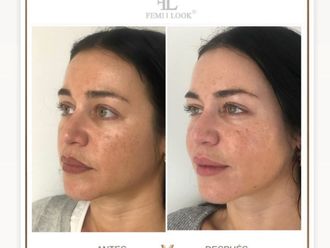 Ácido hialurónico antes y después - 877492