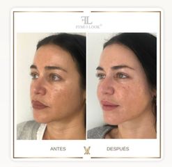 XV Clinic - Tratamiento FemiLook