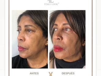 Ácido hialurónico antes y después - 877493