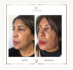 XV Clinic - Tratamiento FemiLook