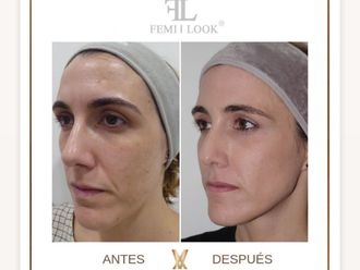 Ácido hialurónico antes y después - 877494