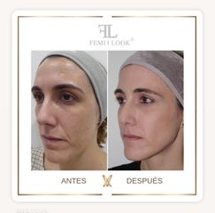 XV Clinic - Tratamiento FemiLook