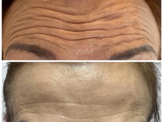 Eliminación arrugas antes y después - 877662