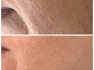 Exosomas antes y después - 877663