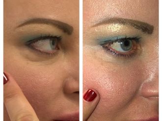 Mesoterapia antes y después - 877664