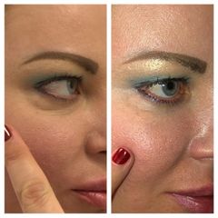 Mesoterapia periocular