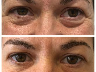 Eliminación ojeras antes y después - 877665