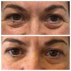 Tratamiento de las ojeras