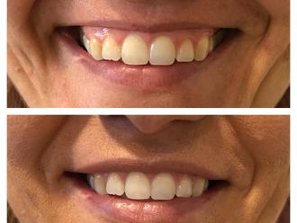 Aumento labios antes y después - 877666