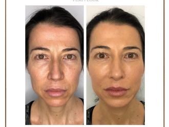 Ácido hialurónico antes y después - 877668