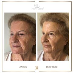 XV Clinic - FemiLook