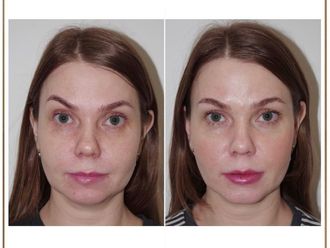 Ácido hialurónico antes y después - 877670