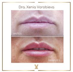 Tratamiento de labios