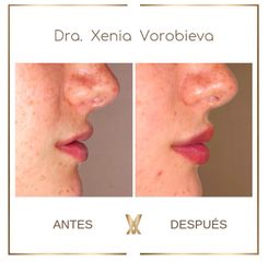 Tratamiento de labios