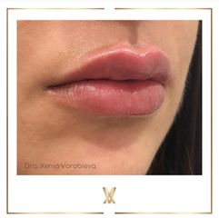Tratamiento de labios