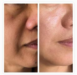 Tratamiento de surco nasogeniano