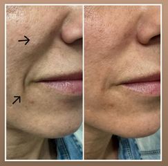 Tratamiento de surco nasogeniano