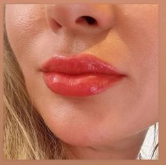 Tratamiento labios