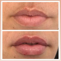 Tratamiento labios