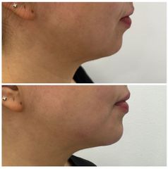 Tratamiento de mentón