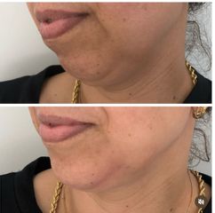 Tratamiento de mentón