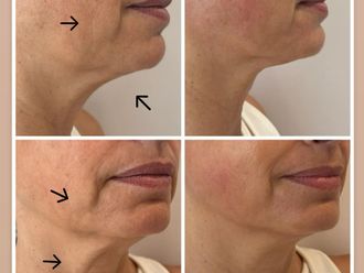 Radiofrecuencia facial antes y después - 877891
