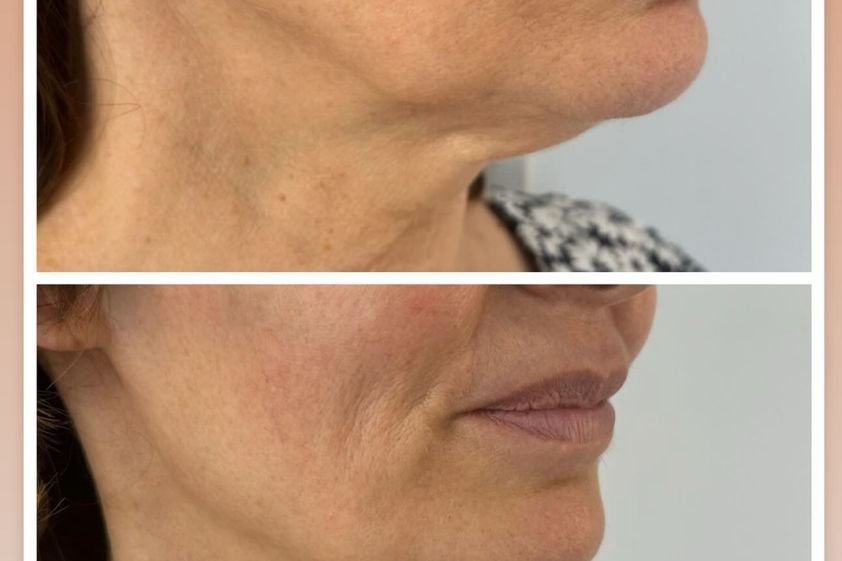 Radiofrecuencia facial antes y después - 877892