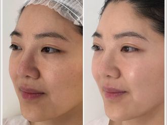 Radiofrecuencia facial antes y después - 877893