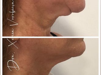 Radiofrecuencia facial antes y después - 877894