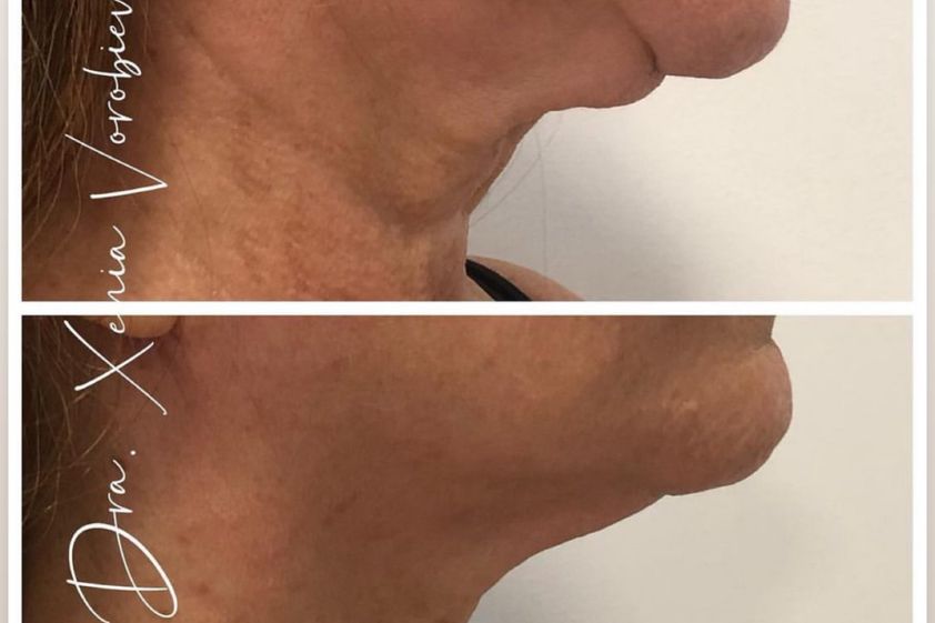 Radiofrecuencia facial antes y después - 877894