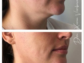 Radiofrecuencia facial antes y después - 877895