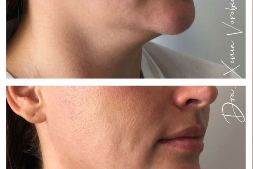 Radiofrecuencia facial antes y después - 877895