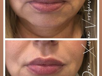 Ácido hialurónico antes y después - 877896