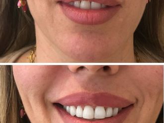 Ácido hialurónico antes y después - 877897