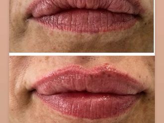 Ácido hialurónico antes y después - 877898