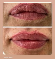 Tratamiento labios