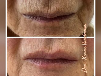 Ácido hialurónico antes y después - 877899