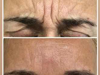 Eliminación arrugas antes y después - 877913