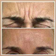 Tratamiento antiarrugas