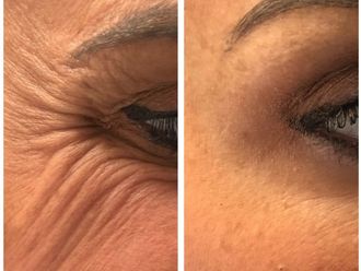 Eliminación arrugas antes y después - 877914